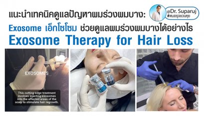 แนะนำเทคนิคดูแลปัญหาผมร่วงผมบาง: Exosome เอ็กโซโซม ช่วยดูแลผมร่วงผมบางได้อย่างไร Exosome Therapy for Hair Loss